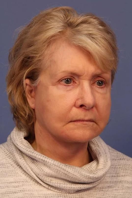 Dauwe Plastic Surgery facelift after — Dallas, TX