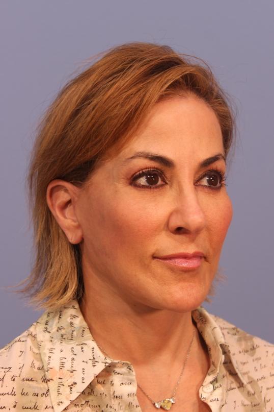 Facelift after at Dauwe Plastic Surgery in Dallas, TX