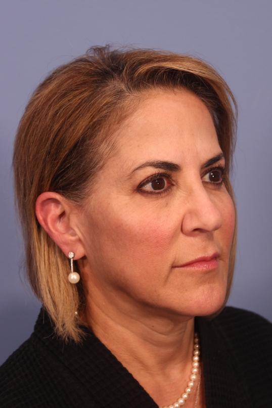 Facelift before at Dauwe Plastic Surgery in Dallas, TX