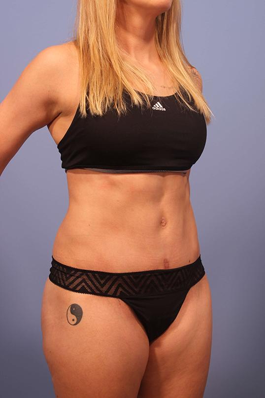 Dauwe Plastic Surgery tummy tuck after — Dallas, TX