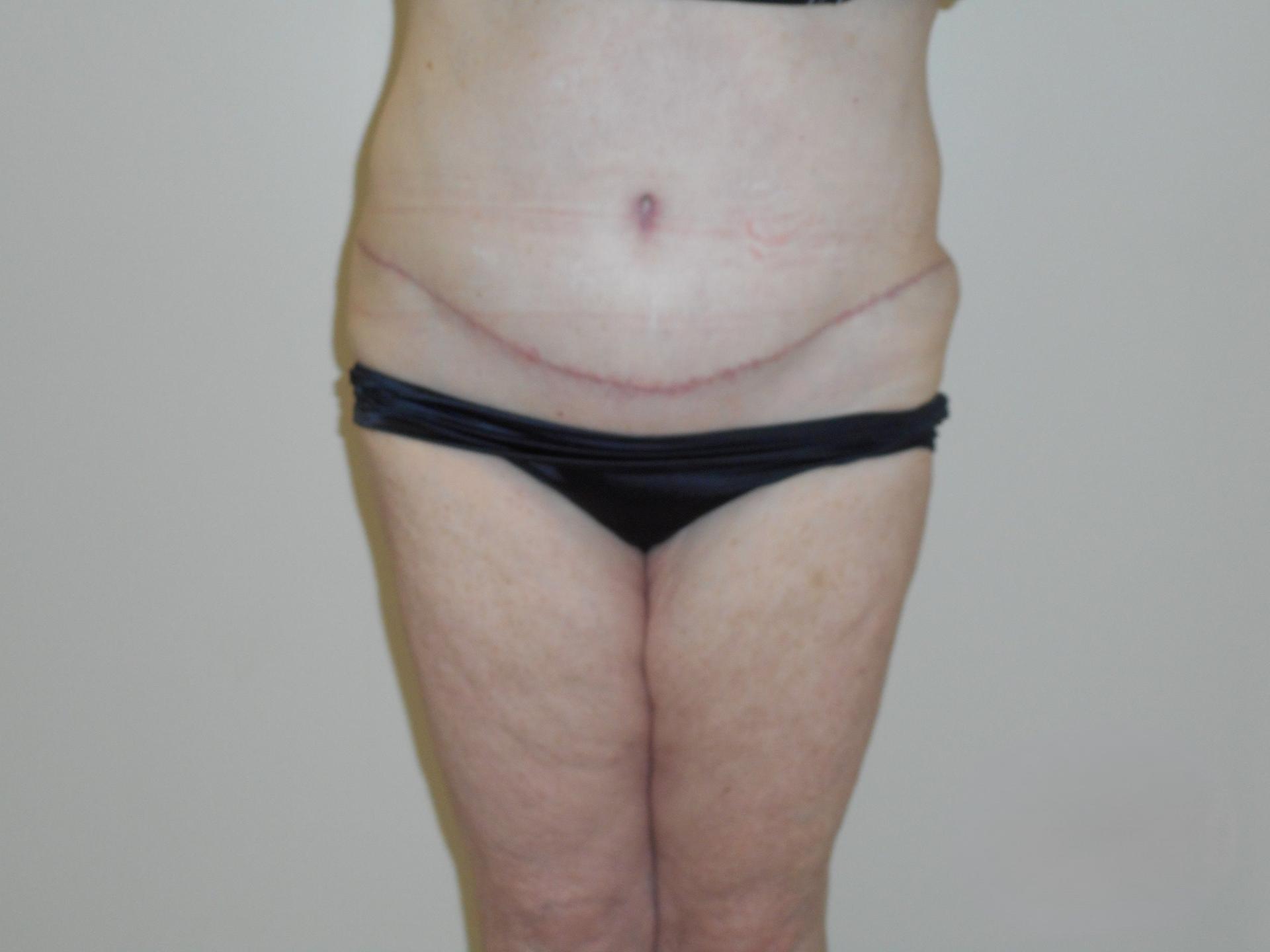 Suburban Plastic Surgeons tummy tuck after — Jenkintown, PA
