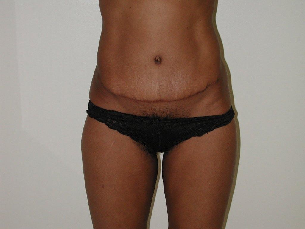 Suburban Plastic Surgeons tummy tuck after — Jenkintown, PA