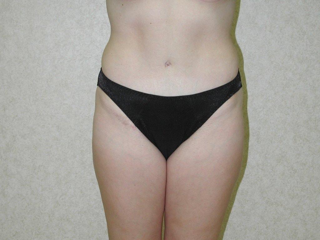 Suburban Plastic Surgeons tummy tuck after — Jenkintown, PA