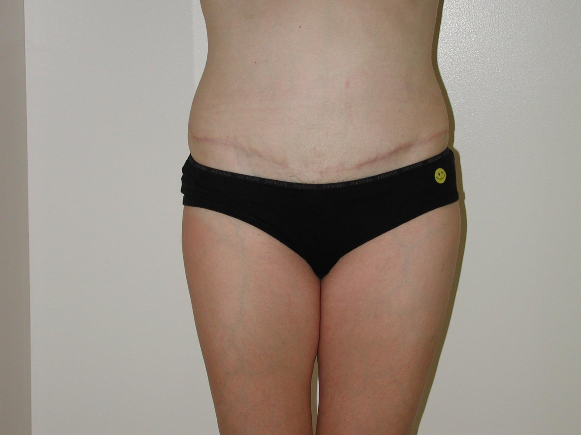 Suburban Plastic Surgeons tummy tuck after — Jenkintown, PA