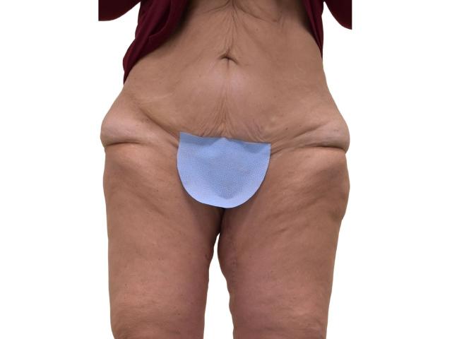 Thigh Lift after at Ava Bello Plastic Surgery in Miami Beach, FL