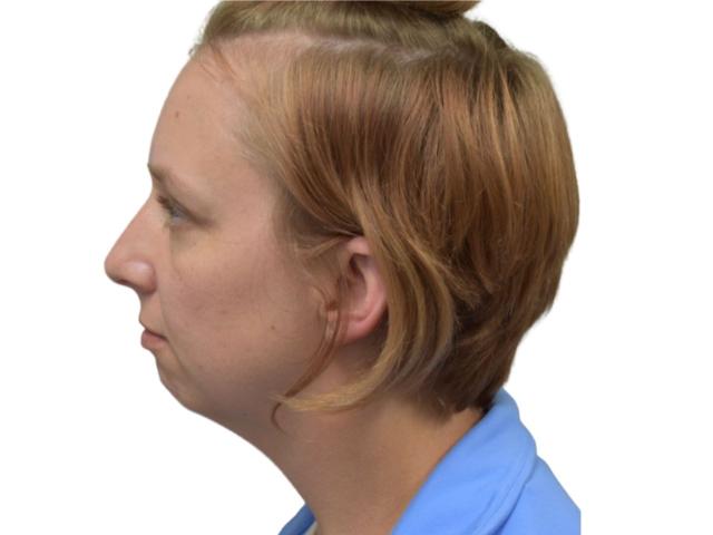 Chin Implant before at Ava Bello Plastic Surgery in Miami Beach, FL