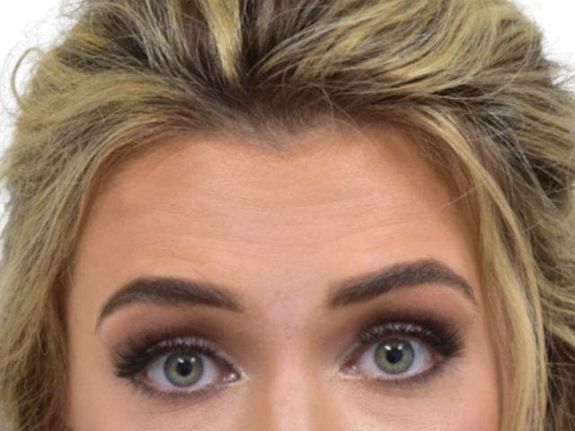 Botox before at Ava Bello Plastic Surgery in Miami Beach, FL