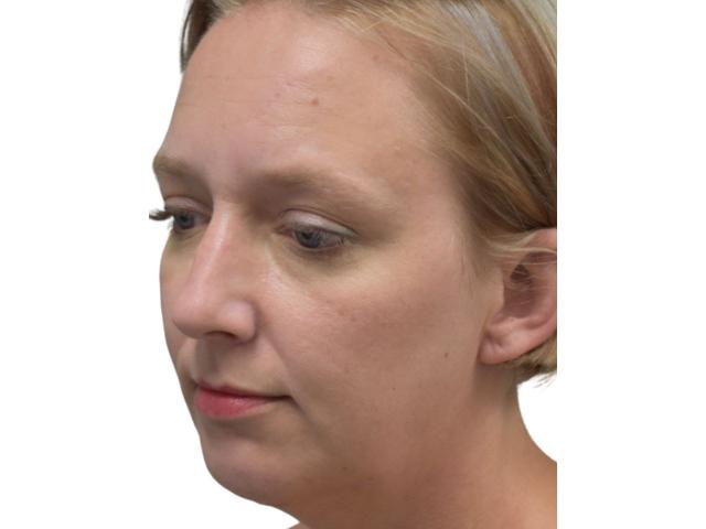 Chin Implant after at Ava Bello Plastic Surgery in Miami Beach, FL