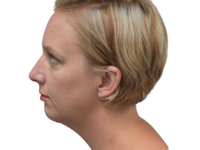 Chin Implant after at Ava Bello Plastic Surgery in Miami Beach, FL