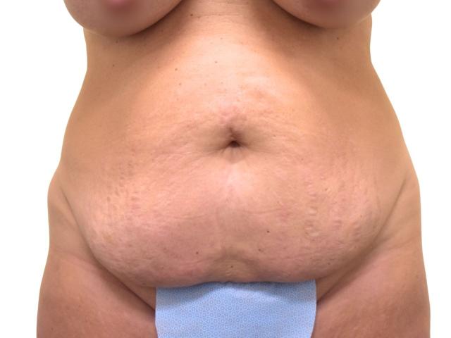 Mini Tummy Tuck before at Ava Bello Plastic Surgery in Miami Beach, FL