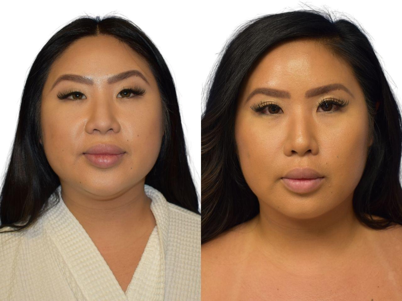 Ava Bello Plastic Surgery liposuction result — Miami Beach, FL