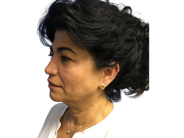 Mini Facelift before at Ava Bello Plastic Surgery in Miami Beach, FL