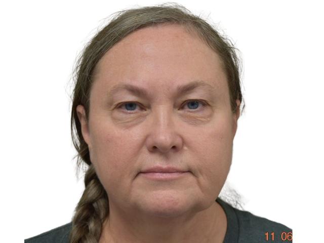 Blepharoplasty before at Ava Bello Plastic Surgery in Miami Beach, FL