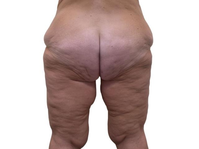 Thigh Lift before at Ava Bello Plastic Surgery in Miami Beach, FL