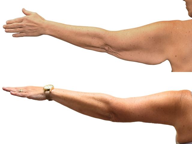 Arm Lift result at Ava Bello Plastic Surgery in Miami Beach, FL