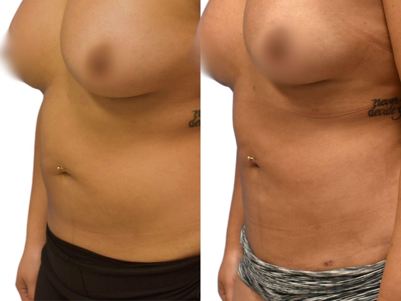 Ava Bello Plastic Surgery liposuction result — Miami Beach, FL