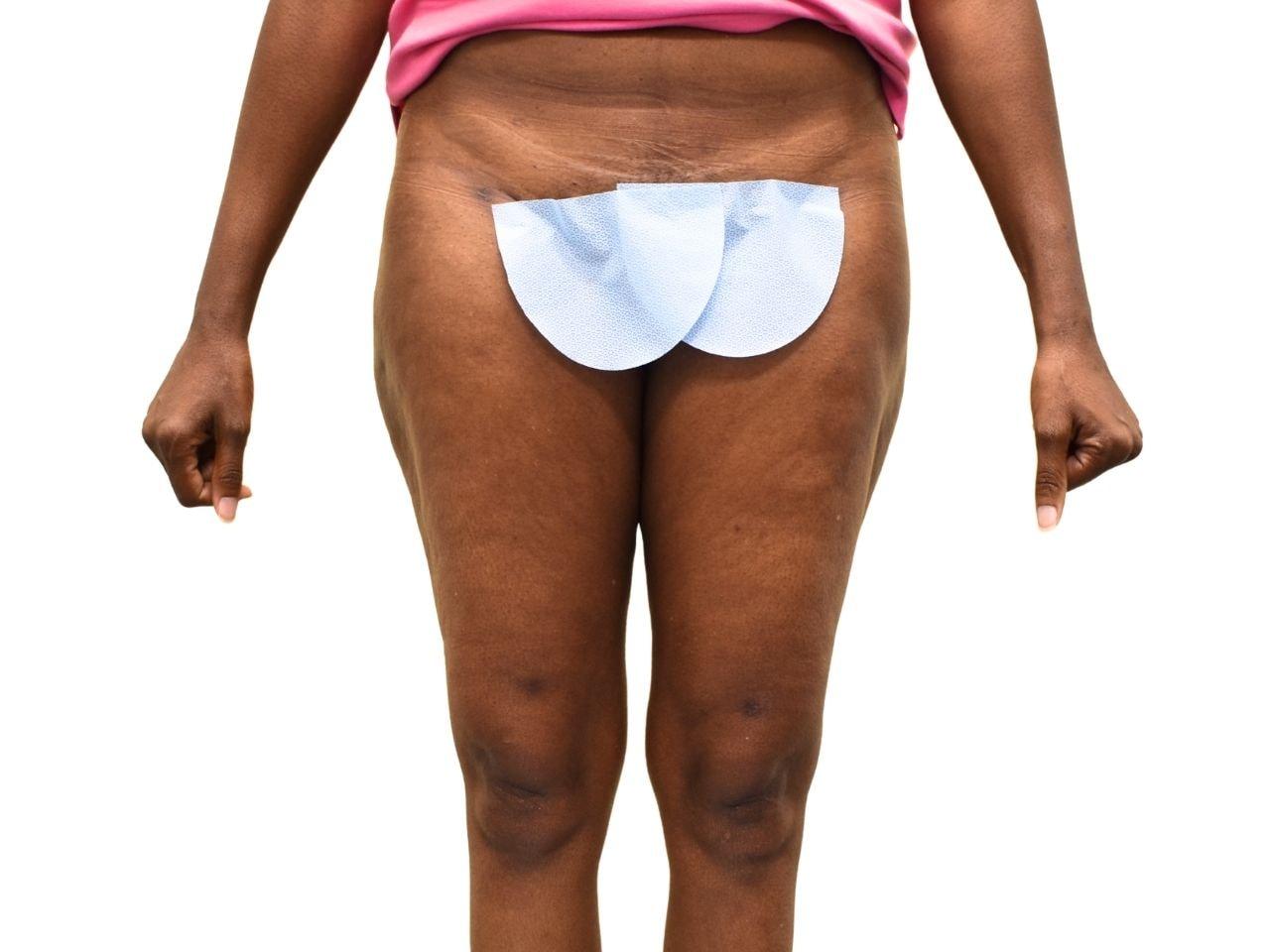 Ava Bello Plastic Surgery liposuction after — Miami Beach, FL