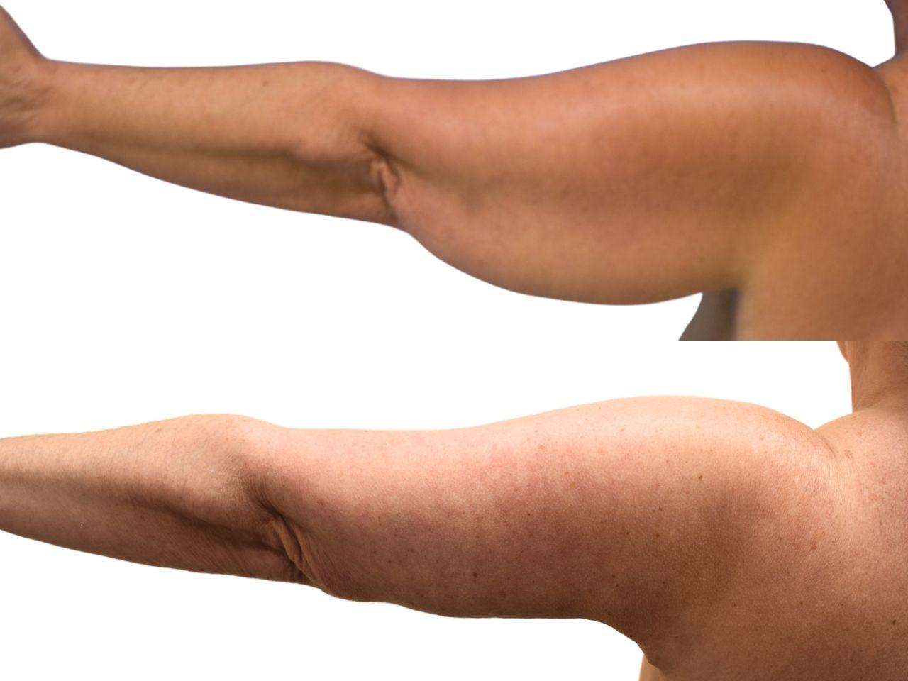 Ava Bello Plastic Surgery arm lift result — Miami Beach, FL