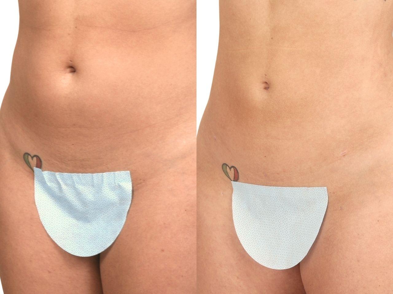 Ava Bello Plastic Surgery liposuction result — Miami Beach, FL
