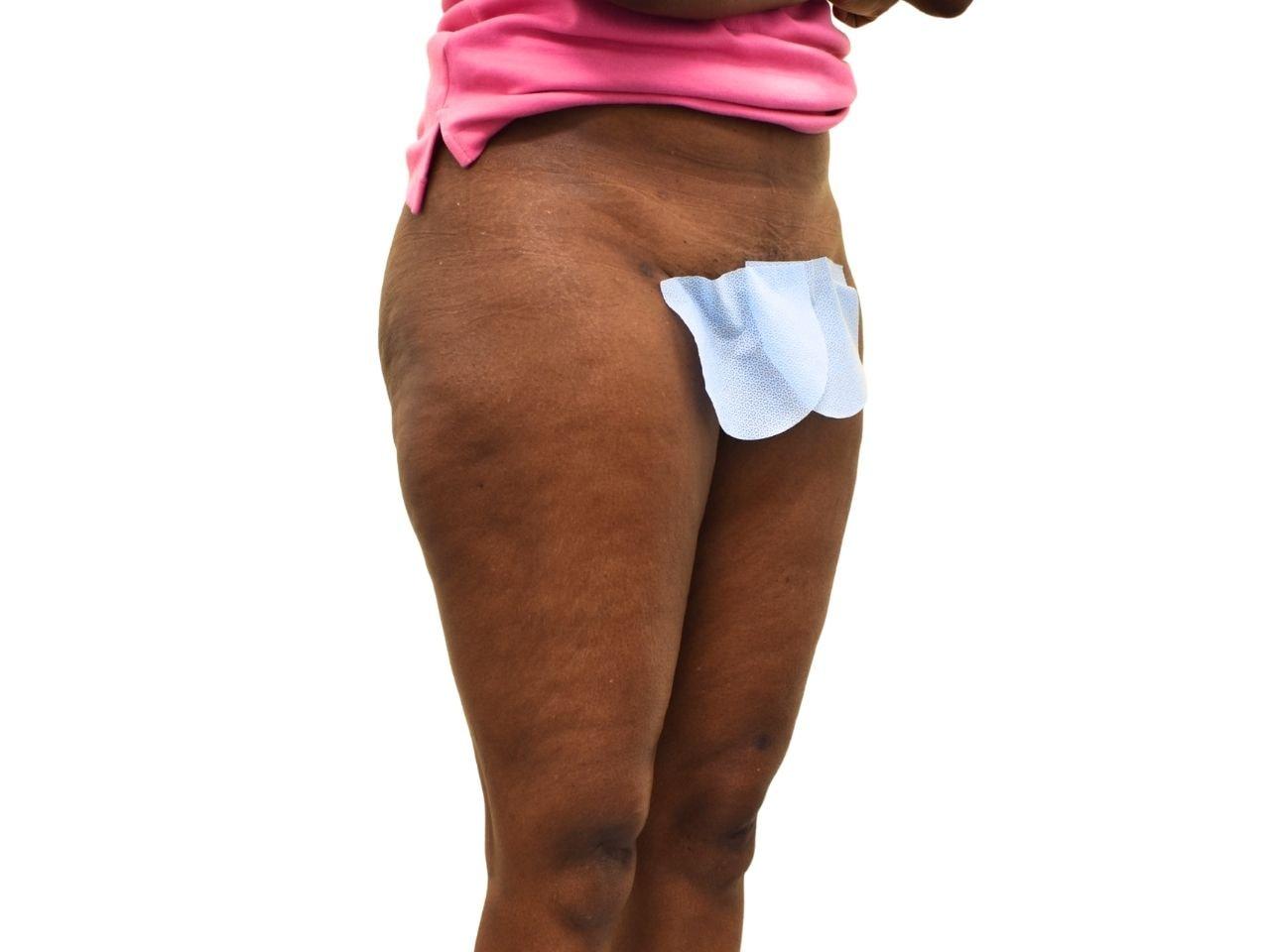 Ava Bello Plastic Surgery liposuction after — Miami Beach, FL