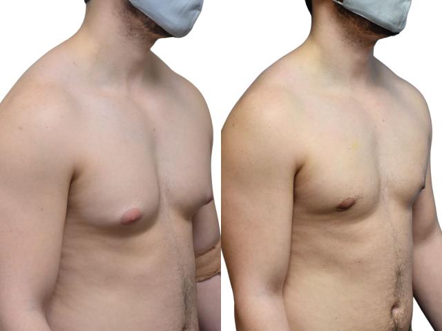 Gynecomastia Surgery result at Ava Bello Plastic Surgery in Miami Beach, FL