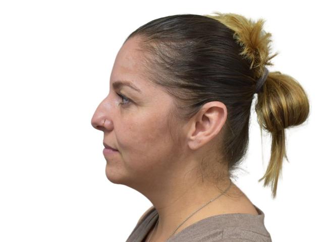 Functional Rhinoplasty before at Ava Bello Plastic Surgery in Miami Beach, FL