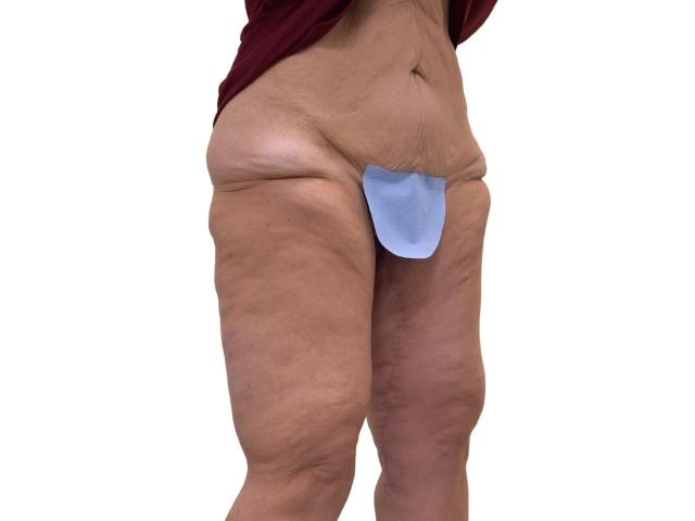 Thigh Lift after at Ava Bello Plastic Surgery in Miami Beach, FL