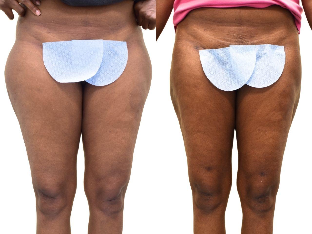 Ava Bello Plastic Surgery liposuction result — Miami Beach, FL