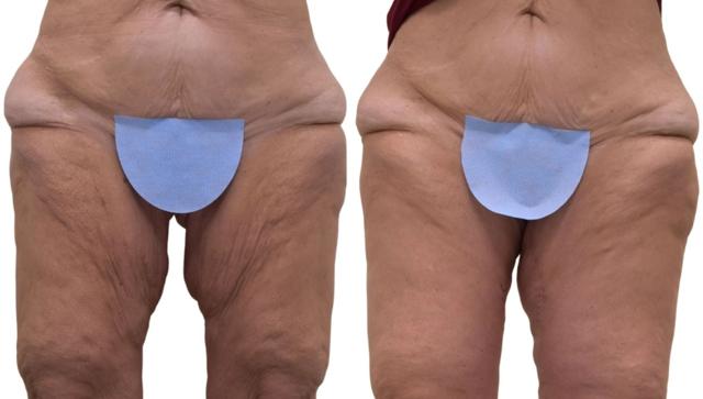 Thigh Lift result at Ava Bello Plastic Surgery in Miami Beach, FL