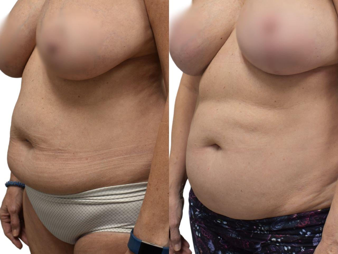 Ava Bello Plastic Surgery liposuction result — Miami Beach, FL