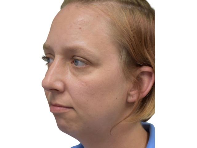 Chin Implant before at Ava Bello Plastic Surgery in Miami Beach, FL