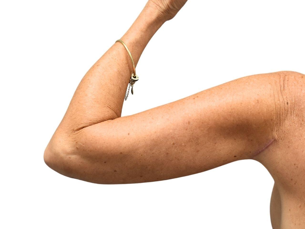 Ava Bello Plastic Surgery arm lift after — Miami Beach, FL