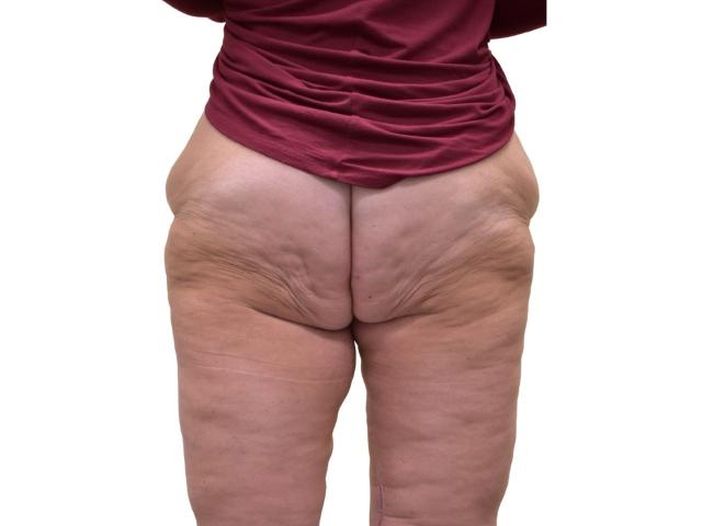 Thigh Lift after at Ava Bello Plastic Surgery in Miami Beach, FL