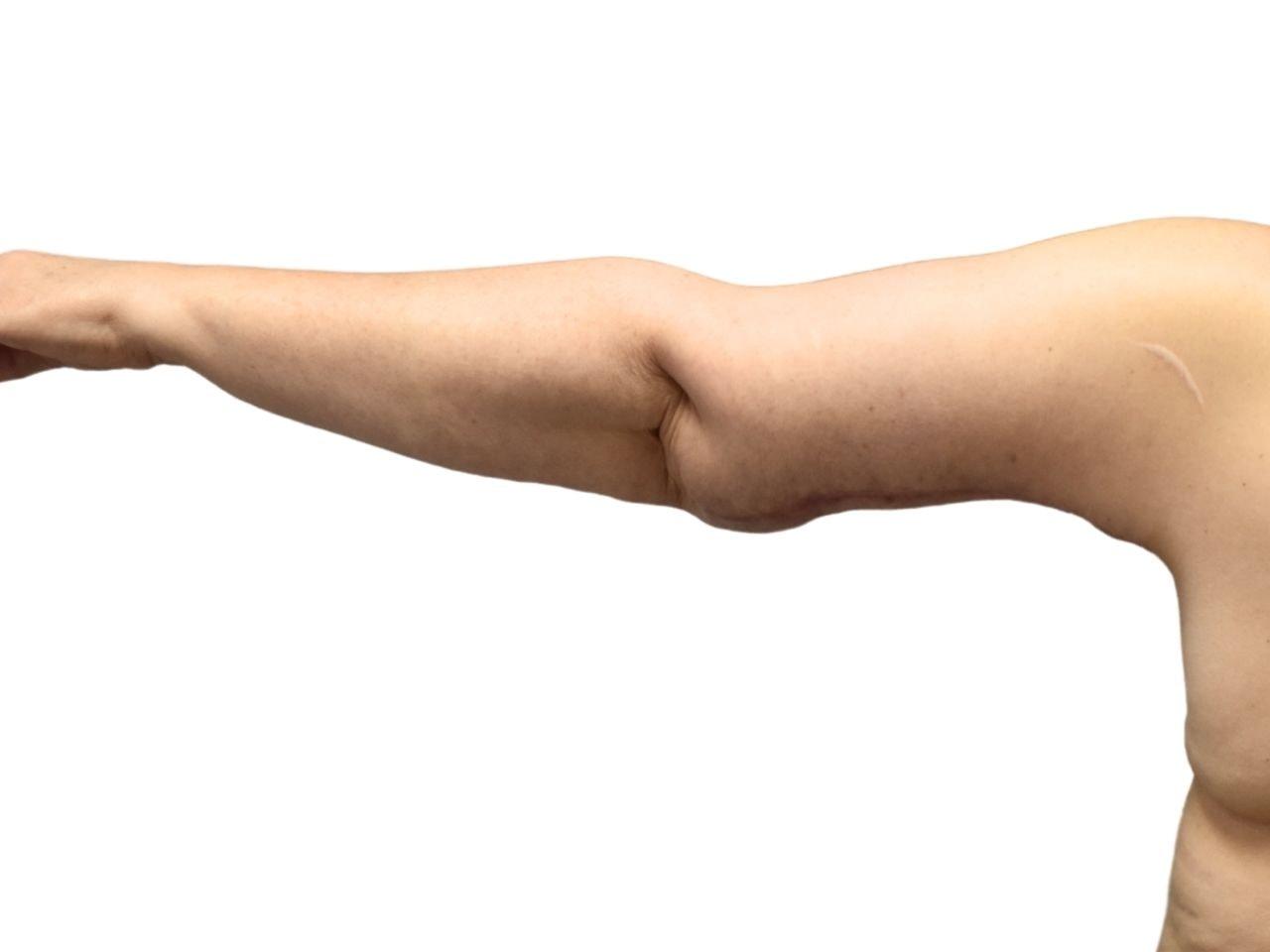 Ava Bello Plastic Surgery arm lift after — Miami Beach, FL