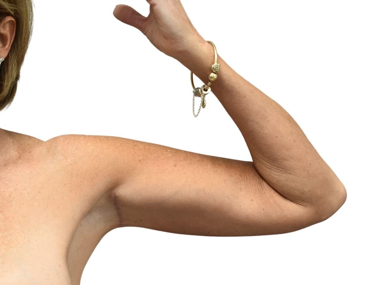 Ava Bello Plastic Surgery arm lift after — Miami Beach, FL