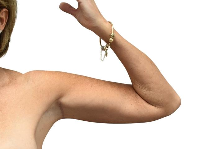 Arm Lift after at Ava Bello Plastic Surgery in Miami Beach, FL