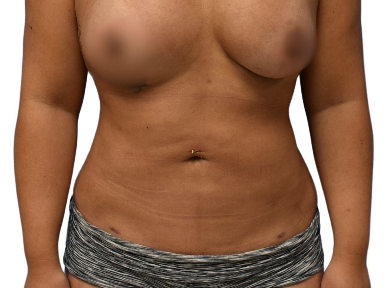 Ava Bello Plastic Surgery liposuction after — Miami Beach, FL