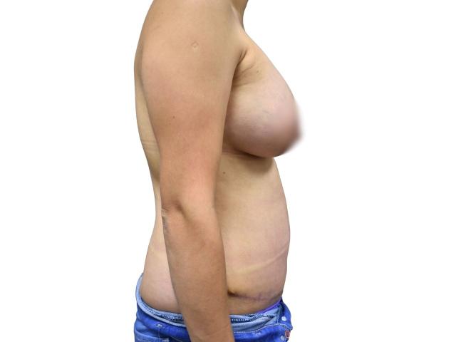 Mommy Makeover after at Ava Bello Plastic Surgery in Miami Beach, FL