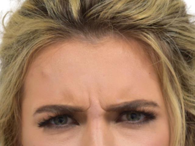 Botox before at Ava Bello Plastic Surgery in Miami Beach, FL