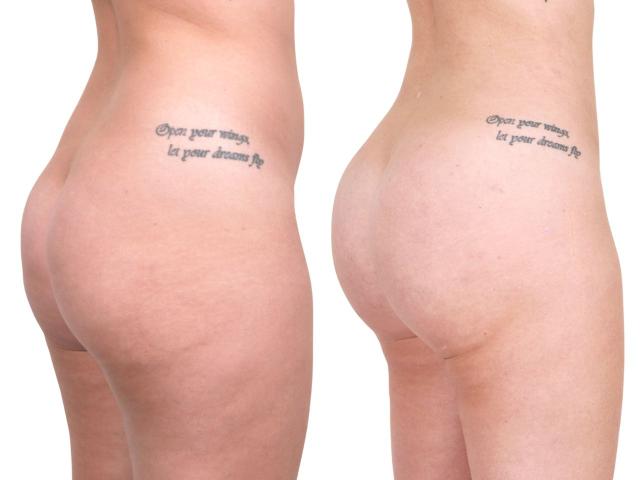 Brazilian Butt Lift result at Ava Bello Plastic Surgery in Miami Beach, FL