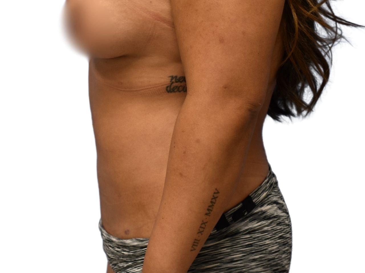 Ava Bello Plastic Surgery liposuction after — Miami Beach, FL