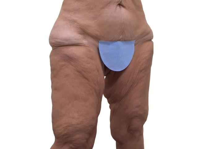 Thigh Lift before at Ava Bello Plastic Surgery in Miami Beach, FL