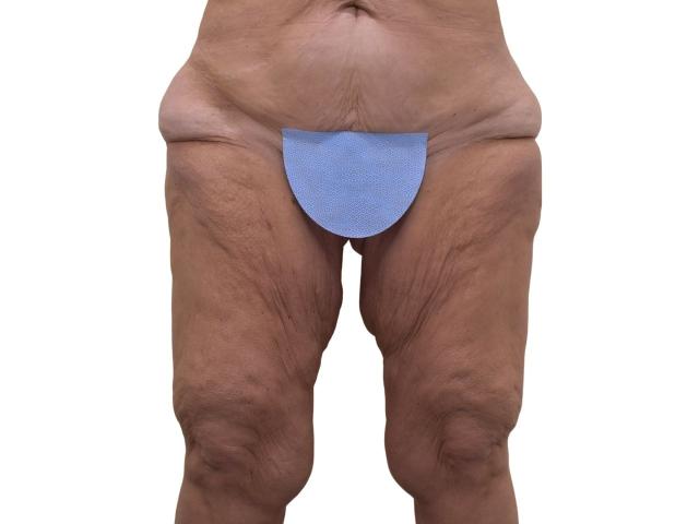Thigh Lift before at Ava Bello Plastic Surgery in Miami Beach, FL