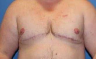 Ultra Aesthetics (Ravinder Jarial, DO) gender affirming top surgery after — West Palm Beach, FL