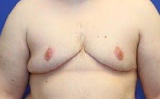 Ultra Aesthetics (Ravinder Jarial, DO) gender affirming top surgery after — West Palm Beach, FL