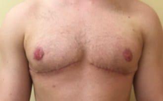 Ultra Aesthetics (Ravinder Jarial, DO) gender affirming top surgery after — West Palm Beach, FL