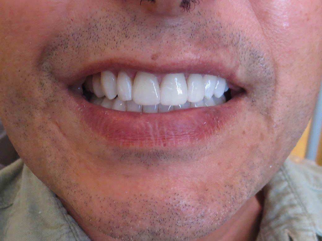 Pacific Beach Smile Studio teeth whitening after — San Diego, CA
