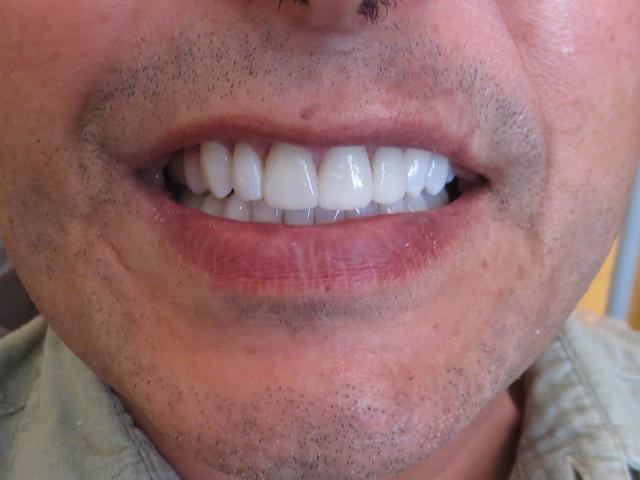Teeth Whitening after at Pacific Beach Smile Studio in San Diego, CA