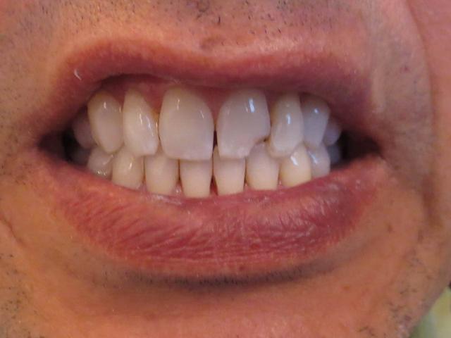 Teeth Whitening before at Pacific Beach Smile Studio in San Diego, CA