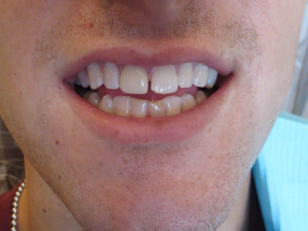 Pacific Beach Smile Studio dental crowns after — San Diego, CA